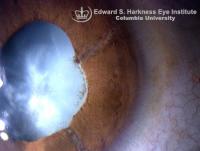Mature Cataract